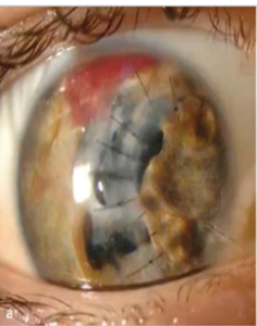 open eye globe injury